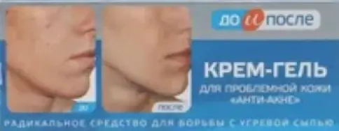 До и После Анти-акне крем для проблемной кожи Туба 50мл